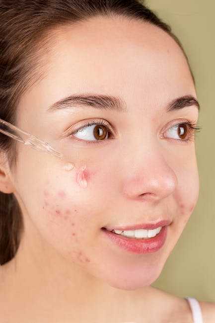 The Benefits of Retinoids for Acne-Prone Skin