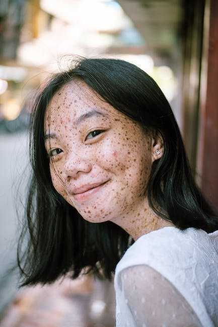 How to Get Rid of Pimples Naturally: A Comprehensive Guide