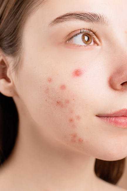 How to Get Rid of Acne Scars: A Comprehensive Guide